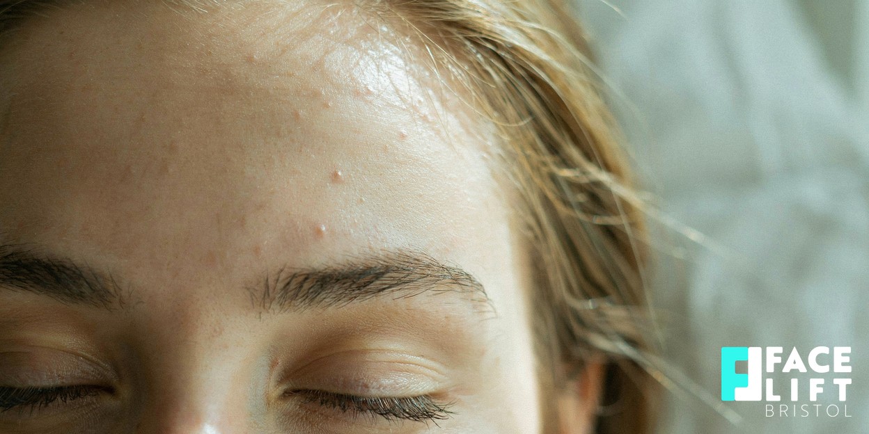 Soft-focus editorial photograph of a person’s forehead and brow area in warm natural daylight, calm and aspirational, conveying facial rejuvenation without any clinical detail