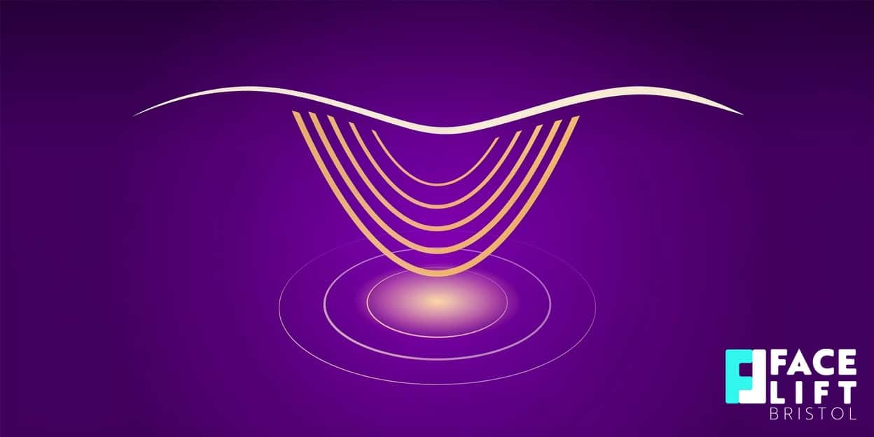 Flat-vector illustration of a stylised soundwave focusing to a single point beneath a skin surface, symbolising focused ultrasound lifting