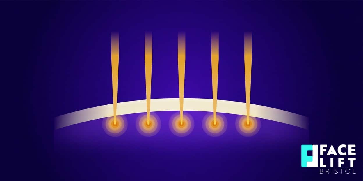 Flat-vector illustration of a fine needle array delivering glowing heat points into a deep skin layer, symbolising radiofrequency microneedling