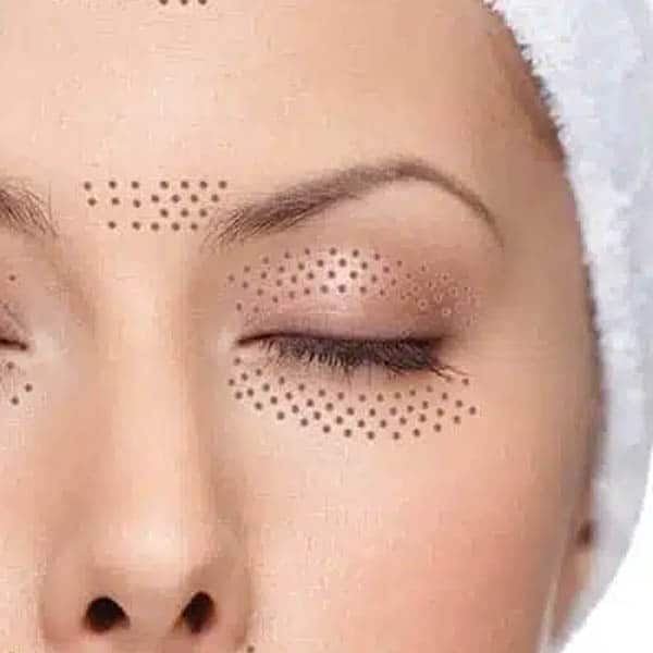 Plasma Fibroblast Eye Lift for hooded and crepey eyelid skin