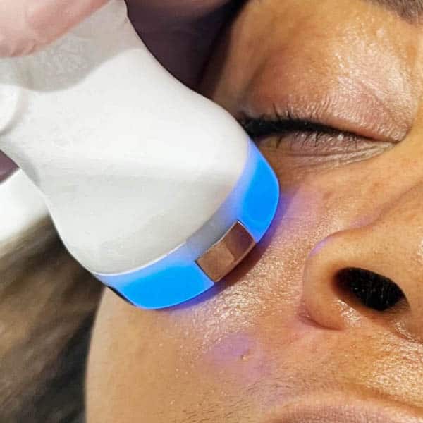 Radiofrequency Facial Skin Lift for firmer, tighter facial skin